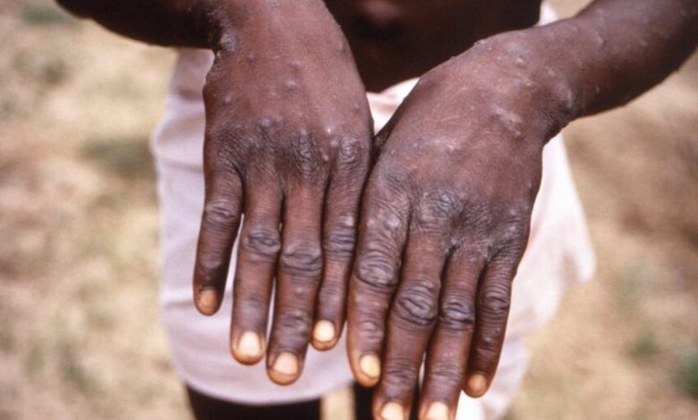 Mpox: What you need to know about rampaging disease