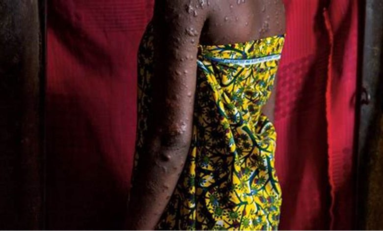 Nigeria records six new Mpox cases