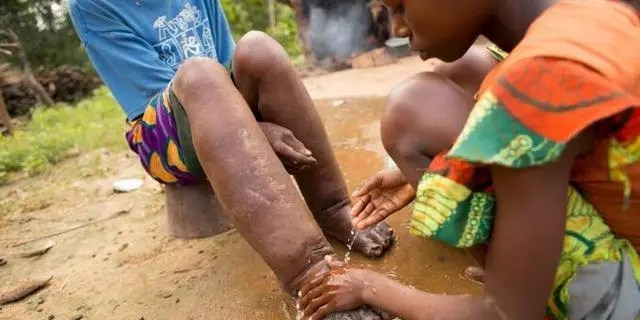 Nigeria needs million to tackle Neglected Tropical Diseases – Official Nigeria needs million to tackle Neglected Tropical Diseases – Official
