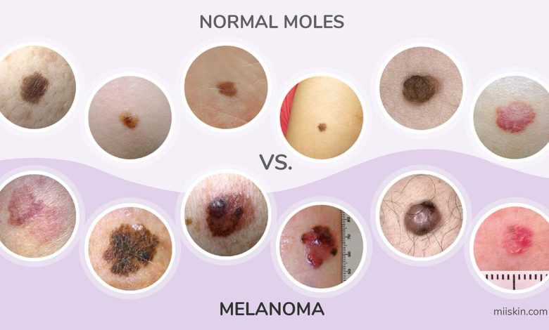 PT Health Watch: How to detect deadly melanoma skin cancer using ABCDE rule PT Health Watch: How to detect deadly melanoma skin cancer using ABCDE rule
