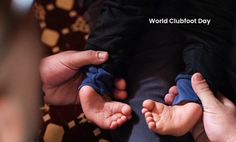 World Clubfoot Day: Health advocates call for increased awareness, timely treatment of patients World Clubfoot Day: Health advocates call for increased awareness, timely treatment of patients