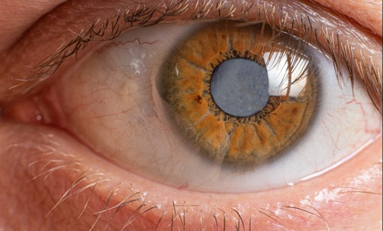PT Health Watch: Expert warns of rising cataracts among young Nigerians PT Health Watch: Expert warns of rising cataracts among young Nigerians
