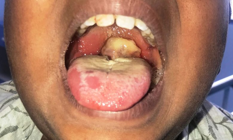 Suspected diphtheria outbreak kills three children in Zaria Suspected diphtheria outbreak kills three children in Zaria