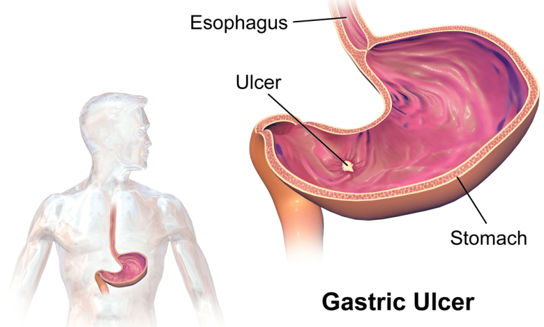 PT Health Watch: What to know about bacteria behind most ulcer cases
