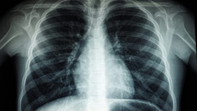 US CDC supports expansion of AI-enabled X-ray machines to tackle Nigeria’s TB-HIV burden