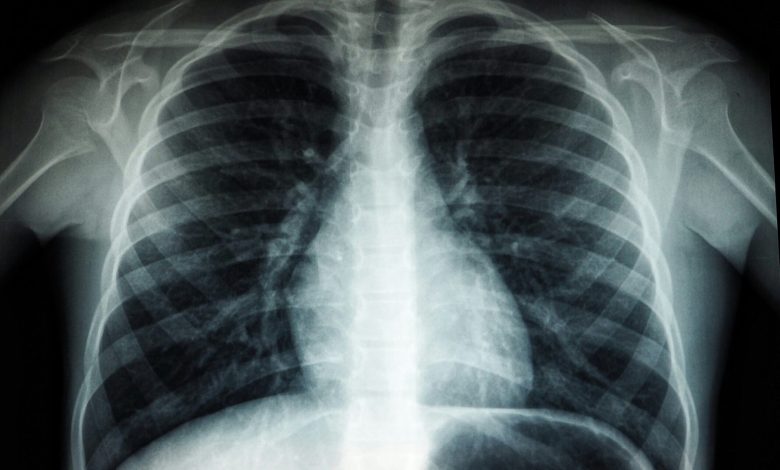 US CDC supports expansion of AI-enabled X-ray machines to tackle Nigeria’s TB-HIV burden US CDC supports expansion of AI-enabled X-ray machines to tackle Nigeria’s TB-HIV burden