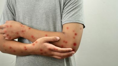 Mpox: 12 cases discovered in Ondo as vaccination commences