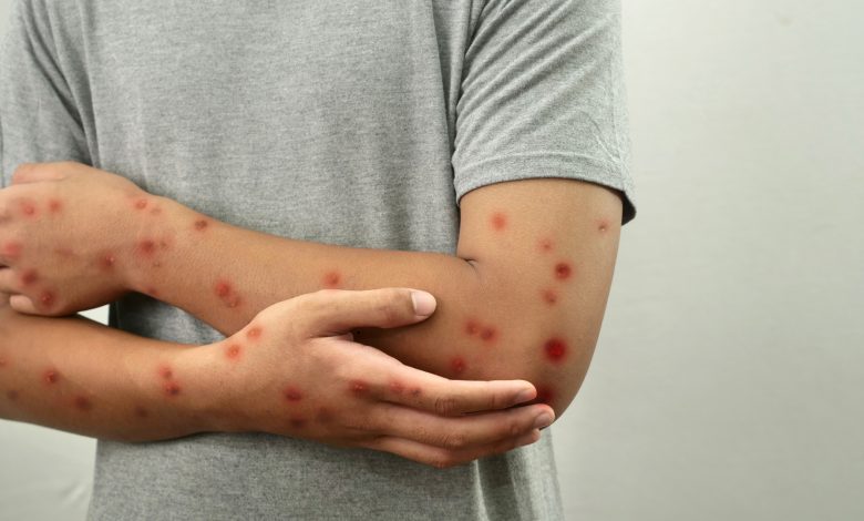 Mpox: 12 cases discovered in Ondo as vaccination commences Mpox: 12 cases discovered in Ondo as vaccination commences