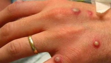 Kaduna to begin monkeypox vaccination in affected LGAs