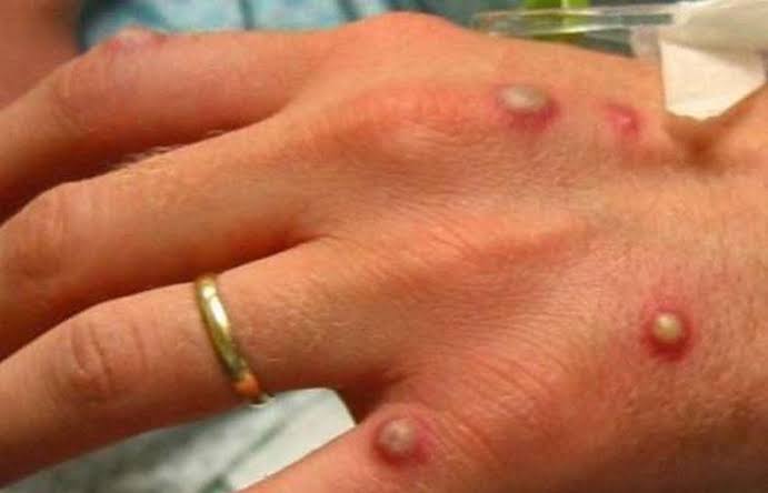 Kaduna to begin monkeypox vaccination in affected LGAs