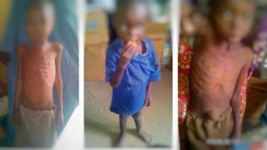 FG raises alarm over Nigeria’s triple burden of malnutrition