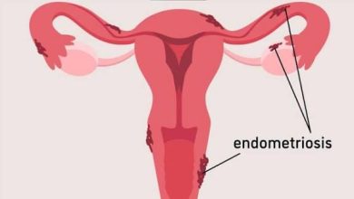 PT Health Watch: What to know about Endometriosis, pain beyond menstruation