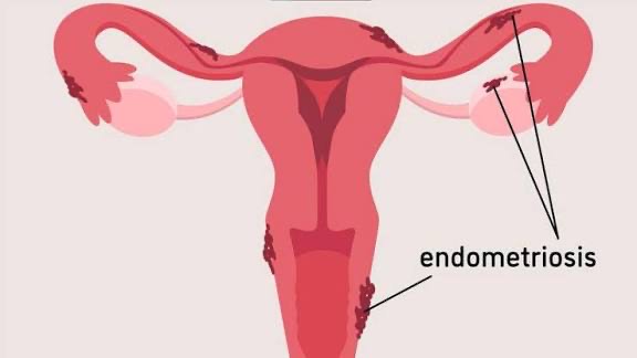 PT Health Watch: What to know about Endometriosis, pain beyond menstruation