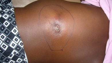 Adamawa confirms eight deaths from suspected Buruli ulcer outbreak