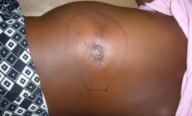 Adamawa confirms eight deaths from suspected Buruli ulcer outbreak
