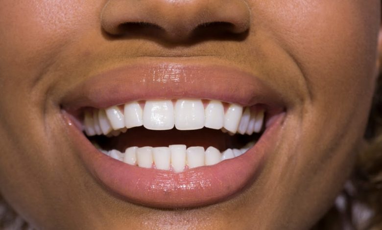 PT Health Watch: Why teeth whitening may harm your oral health
