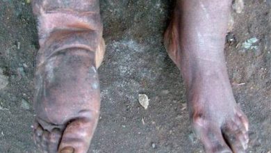 Delta govt offers free surgeries for hydrocele, lymphatic filariasis patients