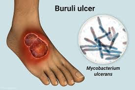 PT Health Watch: What to know about Buruli Ulcer, silent flesh-eating disease PT Health Watch: What to know about Buruli Ulcer, silent flesh-eating disease